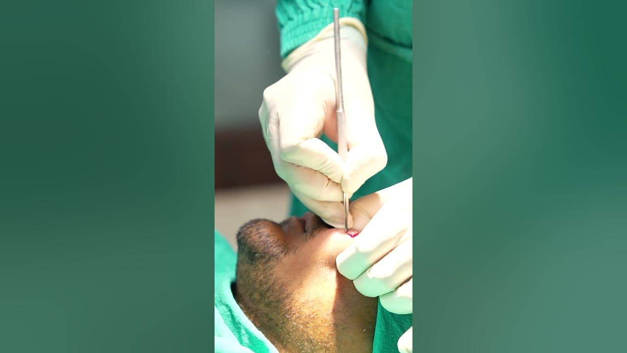 Scar Removal | Scar Revison | Scar Surgery | Scar cost #shortvideo #dezireclinicindia