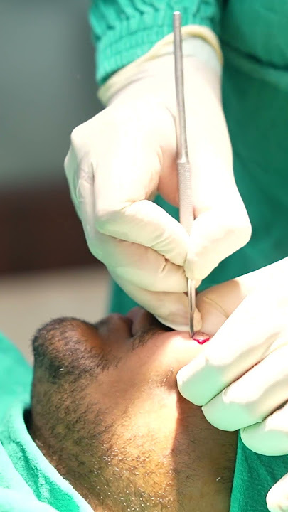 Scar Removal | Scar Revison | Scar Surgery | Scar cost #shortvideo #dezireclinicindia