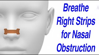 Breathe Right Nasal Strips to Resolve Nasal Obstruction