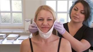 HK Post Operative Chin, Cheek and Jowl Liposuction