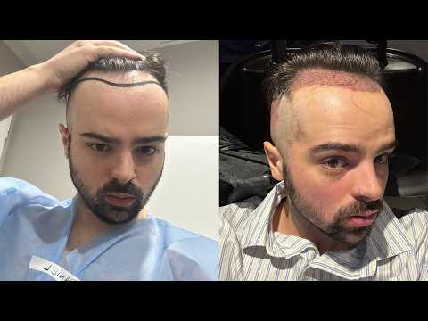 I GOT A HAIR TRANSPLANT...