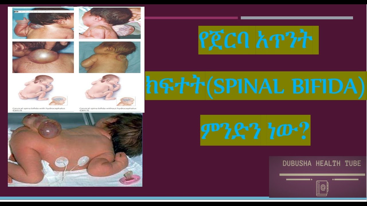 የጀርባ አጥንት ክፍተት(SPINAL BIFIDA) ምንድን ነው?
