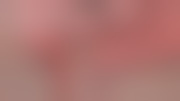 Paediatric Laparoscopic Appendicectomy | Paediatric Appendicitis | Dr. Imran Abdullah Khan