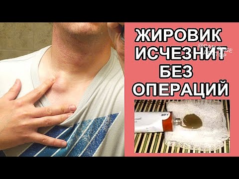 ХИРУРГ НЕ ПОВЕРИЛ,ЧТО Я ИЗБАВИЛАСЬ ОТ ЖИРОВИКА ПРОСТОЙ МАЗЬЮ.GET RID OF THE WEN WITH OINTMENT