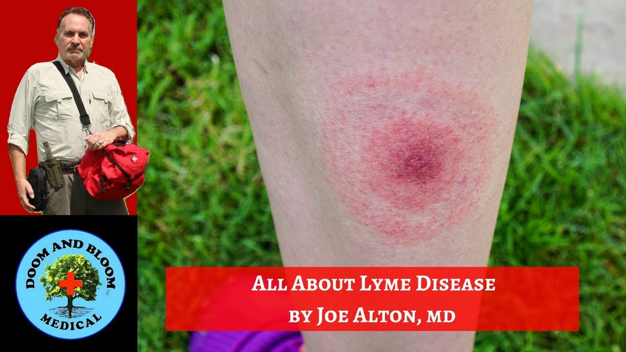 Lyme Disease Prevention Symptoms Stages And Early Treatment Youtube