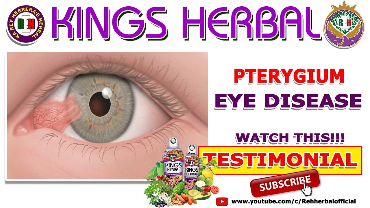 PTERYGIUM EYE DISEASE KINGS Herbal Testimonial YouTube