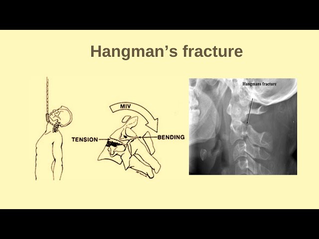 Odontoid and hangman fracture