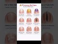 Nail sign #knowledge #learning #students #medicaleducation #medicalstudent #study