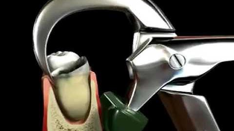 Atraumatic Extraction Forceps