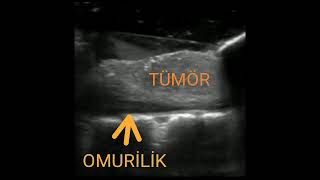 Omurilik Tümörü Ultrason Video  ( Intraoperative Ultrasound intradural Tumor Imaging)