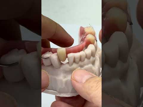 Covering 4 teeth!