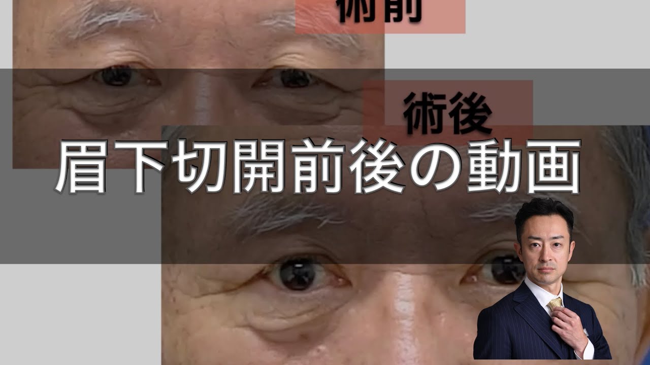 完全版 上眼瞼リフト 眉下切開 の適応 利点 欠点を4人のモデルケースと共に解説 完全版 上眼瞼リフト 眉下切開 の適応 利点 欠点を4人のモデルケースと共に解説