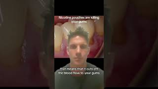 Nicotine pouches are destroying your gums!