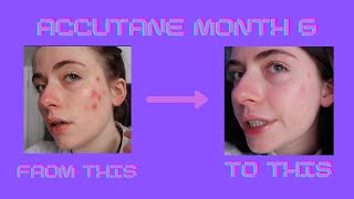 MY ACCUTANE JOURNEY: month 6 | accutane
