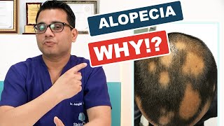 What is Alopecia areata ?- Causes, Diagnosis & Hair Re-growth Treatments? @SkinQure (in Hindi)