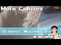 Diabetic Wound Care Under Calluses