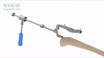 Expert Tibia Nailing System Surgical Technique