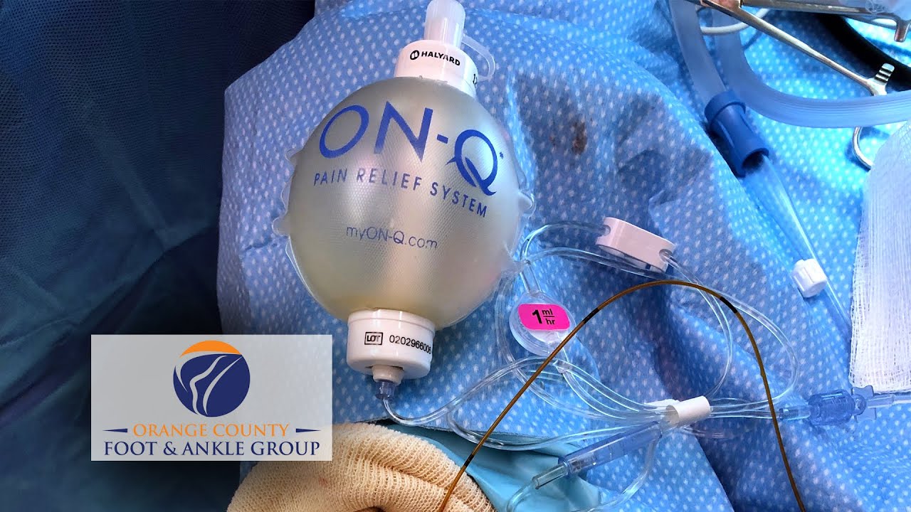 The ON Q Infusion Pain Pump For Regional Anesthesia Pain YouTube The ON Q Infusion Pain Pump For Regional Anesthesia Pain YouTube