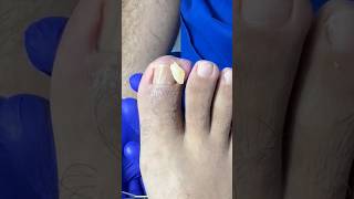 CASO EXTREMO😨 casi se le forma otro dedo 🙁 #ingrown_toenail_surgery #satisfying