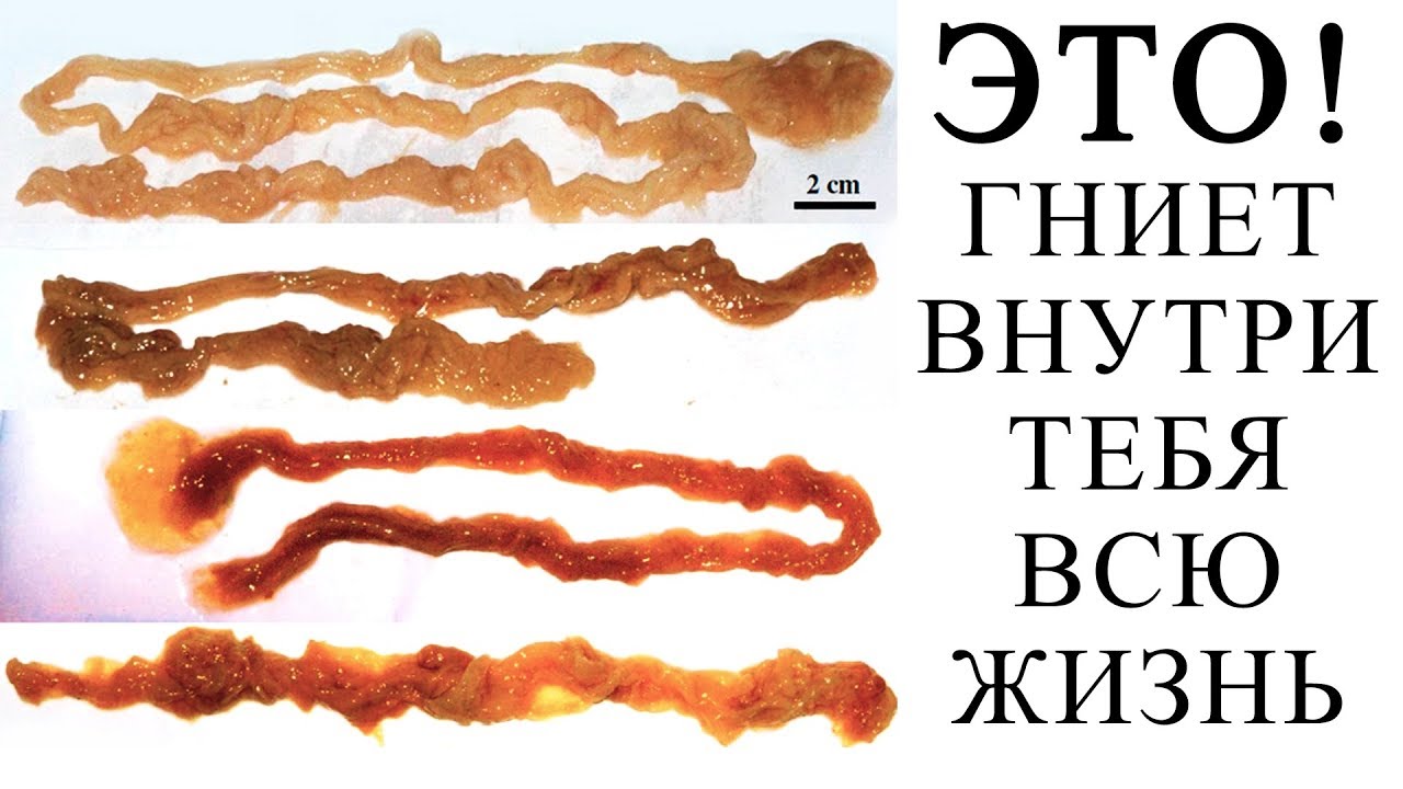 Как очистить кишечник от камней. Каловые камни в кишечнике. Каловые отложения в кишечнике.