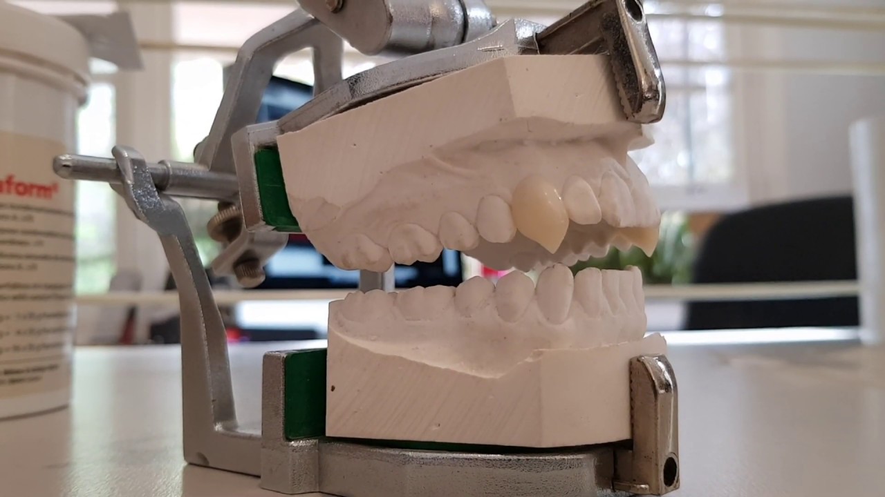 FangSmith Custom Vampire Fangs