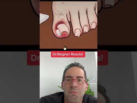 ASMR INGROWN TOENAIL REMOVAL 😜 #shorts #asmr #ingrowntoenail