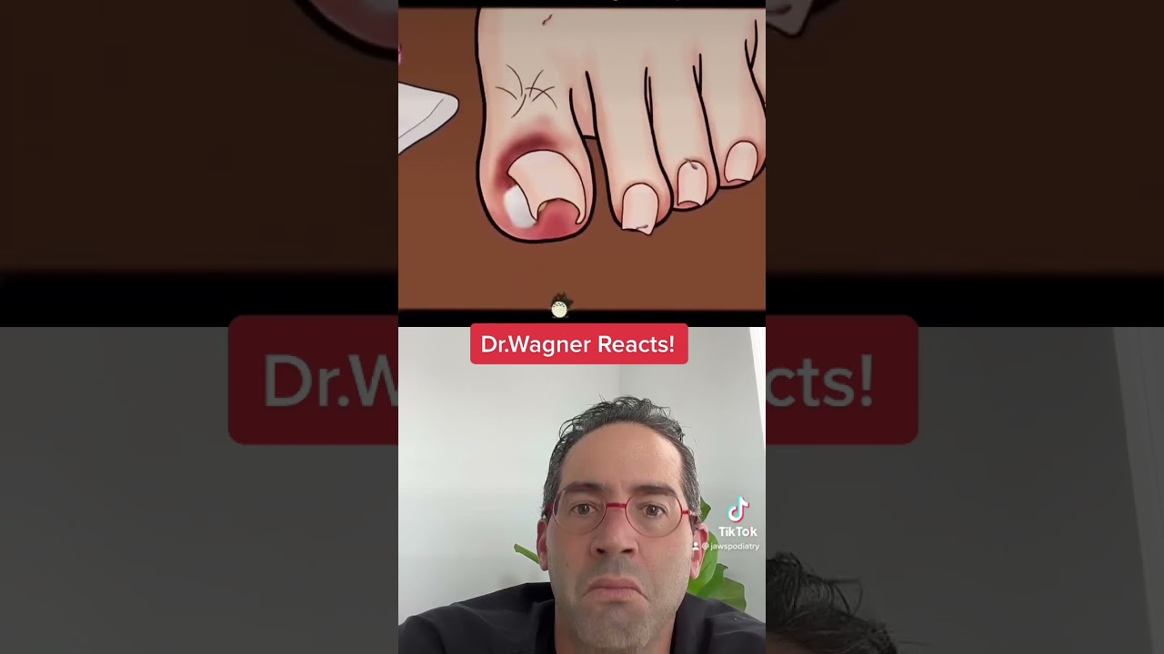 ASMR INGROWN TOENAIL REMOVAL 😜 #shorts #asmr #ingrowntoenail