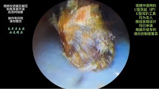 采耳哥-Earwax in the ear canal, which is quite difficult to remove ｜742