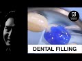 DENTAL FILLING | DENTIST | DR RIZAL RIZKY AKBAR