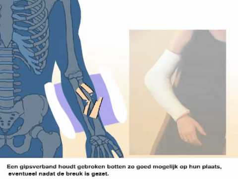 Video: Armbotbreuk - Symptomen, Hoe Arm Na Fractuur Te Ontwikkelen?