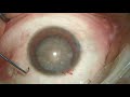 Prechop in dense cataract by dr sohel khans prechopper