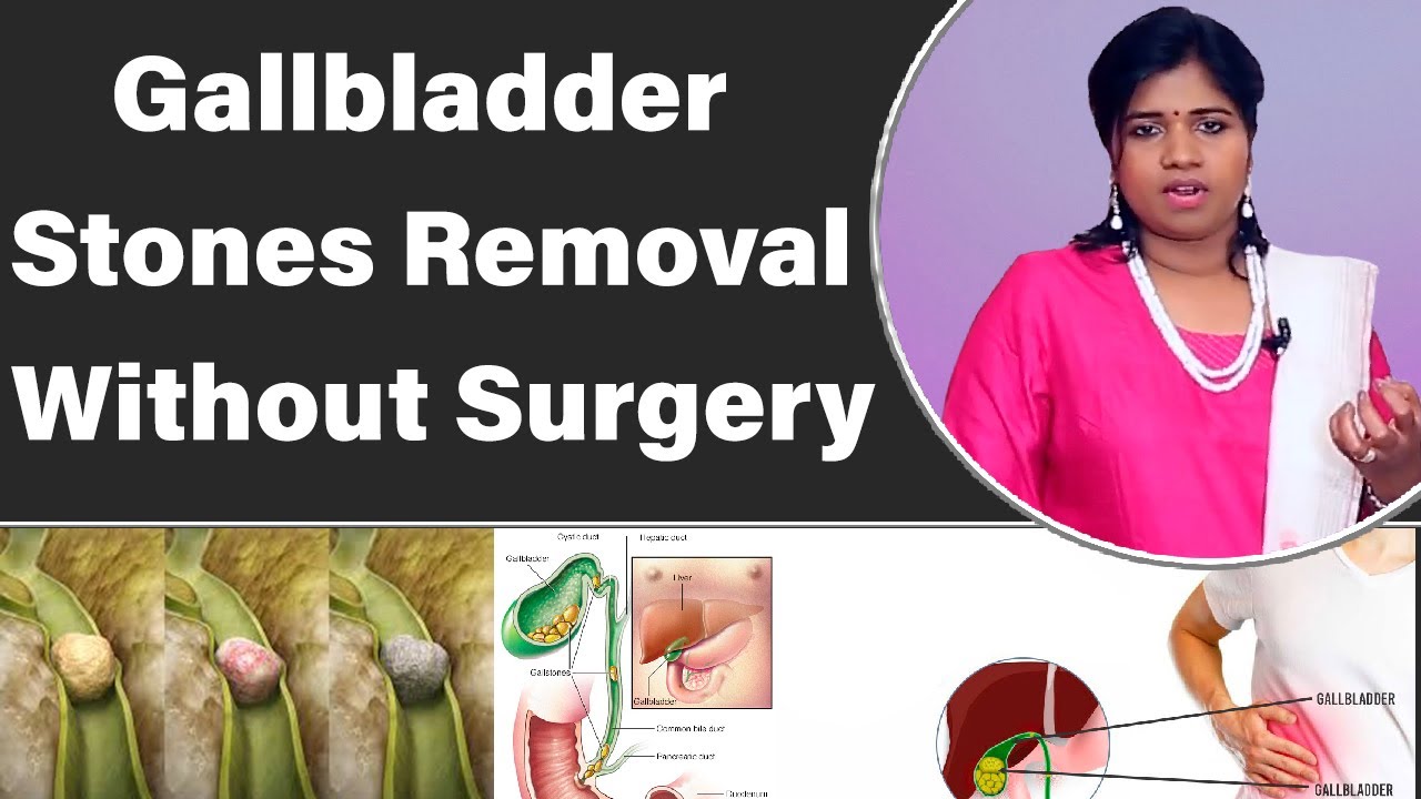 Gall bladder Stone Removal Natural Way | Siddha Treatment Without ...