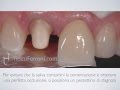 Ecco perchè cementare una corona non è attaccare un dente