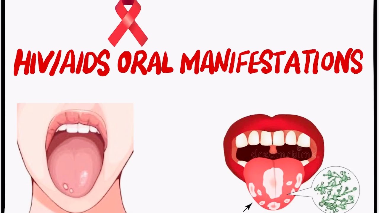 Oral Manifestations Of Hivaids Youtube 