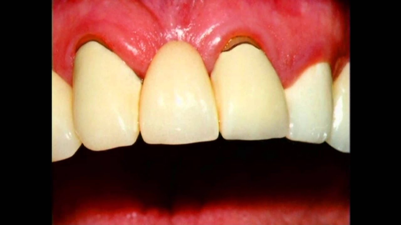 Porcelain Bridges in Cosmetic Dentistry Lake Merritt Dental, Oakland