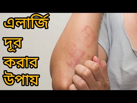 এলার্জির বিভিন্ন ধরণসমূহ  এবং এলার্জি রোধের উপায় গুলো জেনে নিন।।