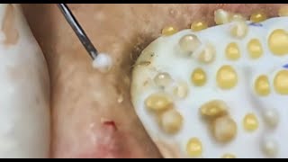 Best of Acne, Pimples & Popping!  So Many Pimple Pops!