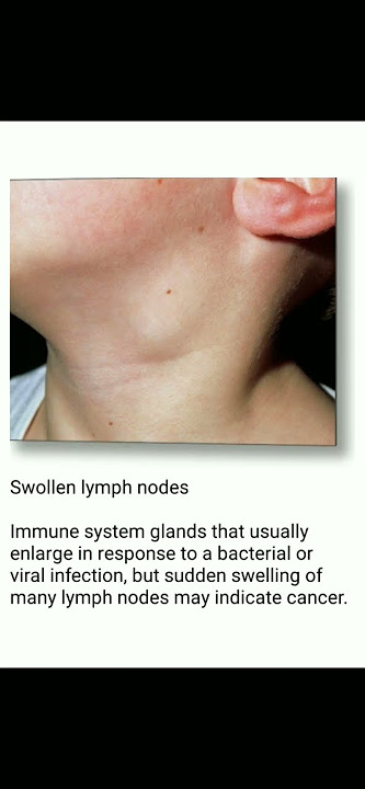 swollen lymph nodes 👌💊⚕️✍️