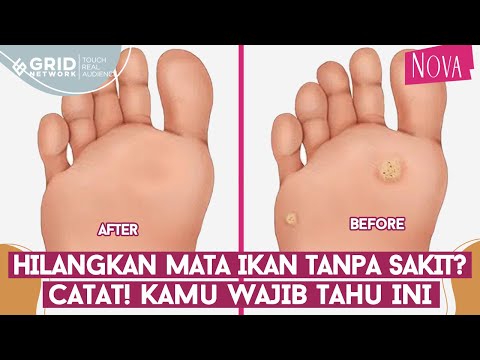 Video: Cara Menghilangkan Pusing: 9 Langkah (dengan Gambar)