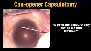 Episode 2 : Capsulotomy in MSICS