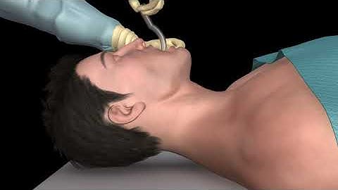Oral airway insertion - oropharyngeal airway technique - 3D animation