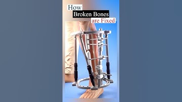 How broken bones are Fixed| Fractured Bone Fixation| #bonefracture #healtheducation #shorts #trend