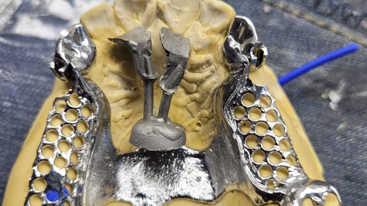 Protesis dentales paso a paso VIDEO COMPLETO REMOBIBLE DE SEMIPRECICION y ATACHES o ADITAMENTOS