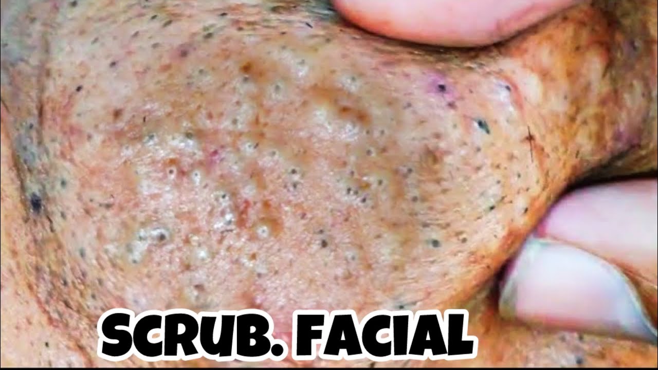 sac be spa blackheads elderly nose | sac be spa old men face blackheads new 2026 | sac be spa facial