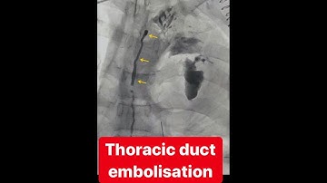 Thoracic duct embolisation (TDE) - a case of chylothorax