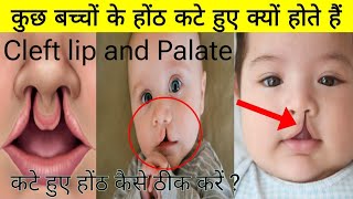 कटे हुए होंठ का इलाज कैसे करें  Cleft lip or palate treatment