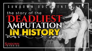 The Deadliest Amputation in History – A Surgery Gone Horribly Wrong