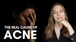 Acne, Shame, and the Fear of Being Seen | The Emotional Roots of Skin Issues