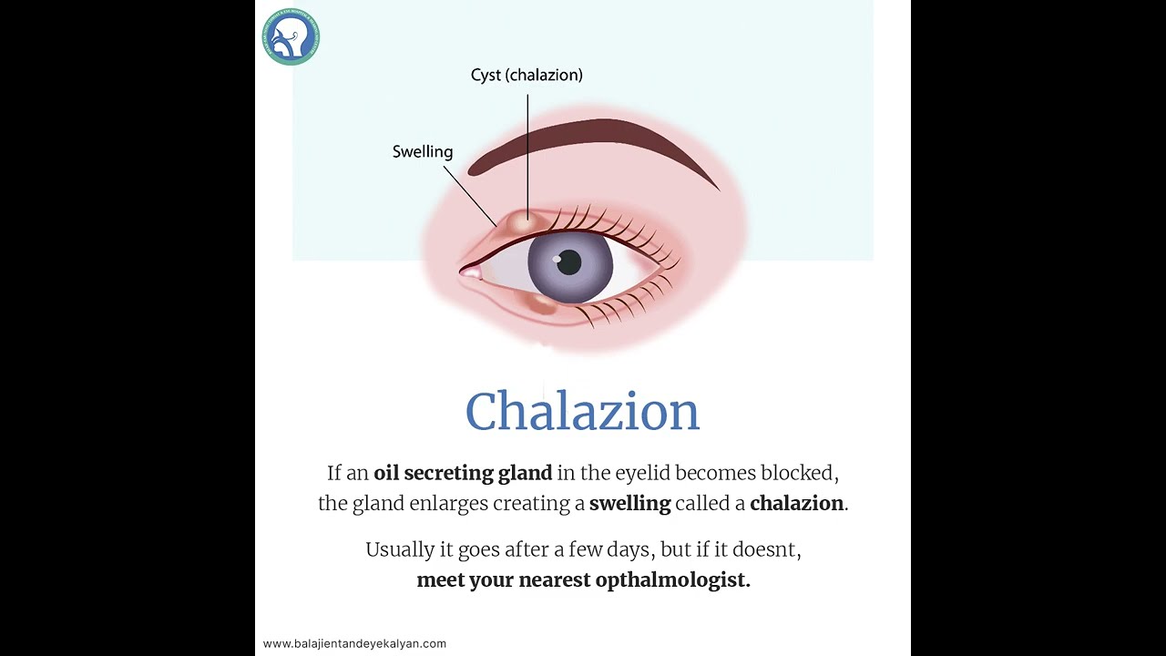 You might have gotten a boil or two in your eye. Let's find a scientific term for this.