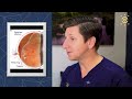 Flashes and Floaters Explained: Dr. Dean, Eye Specialist, for Patients